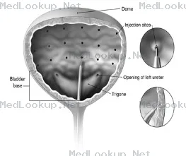 Botox Injection, Powder, Lyophilized, For Solution